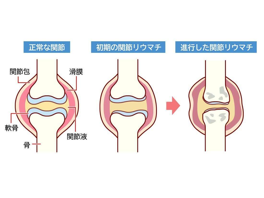膝に水が溜まるってどういうこと？